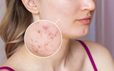 Eliminate Persistent Skin Conditions and Diseases with Detoxification